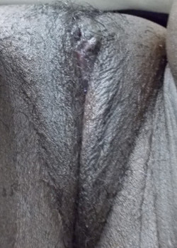 After Image: Labiaplasty - front