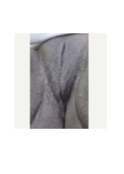 After Image: Vaginoplasty - front