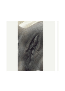 Before Image: Vaginoplasty - front