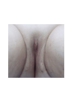 After Image: Vaginoplasty - front