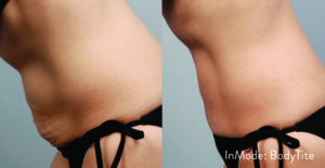 im sm mommytummy 300x155 1