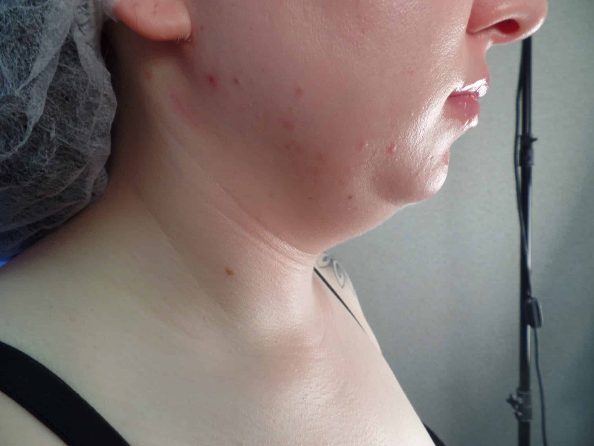 Before Image: Facetite - front