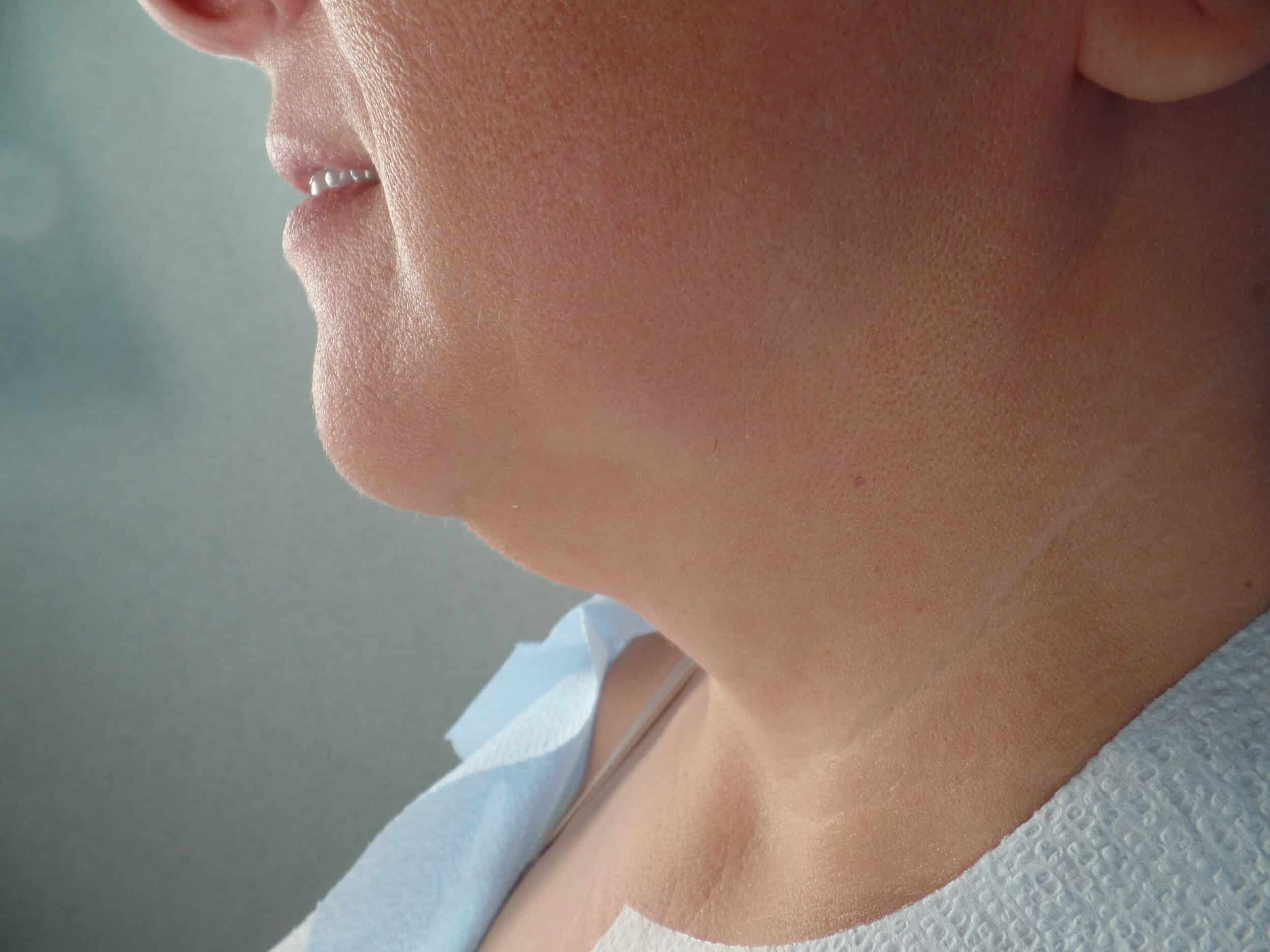 Before Image: Facetite Chin and Jowls - left-side