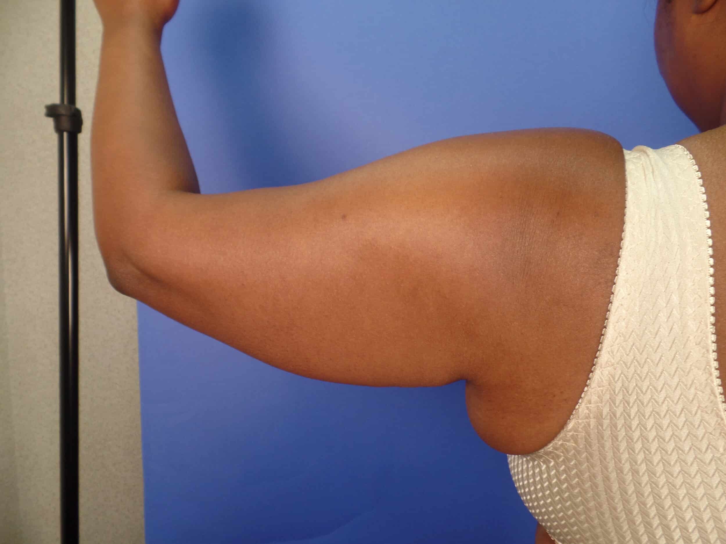 Before Image: Liposuction Arms - back