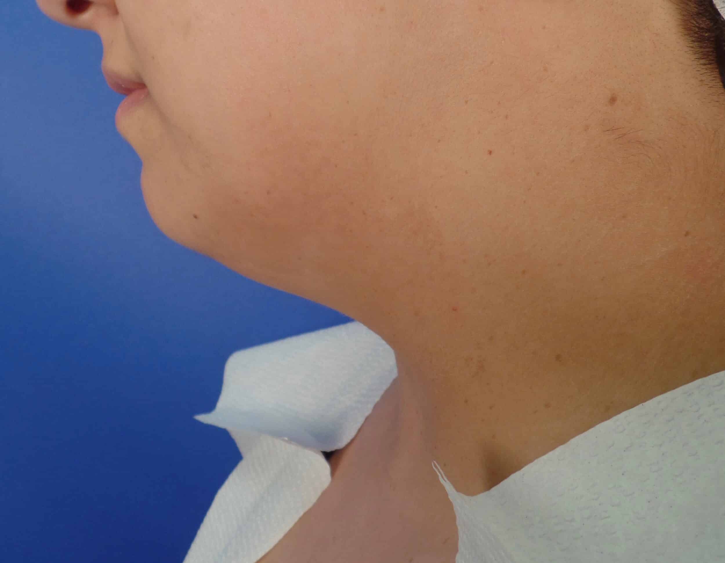 Before Image: Facetite Chin - left-side