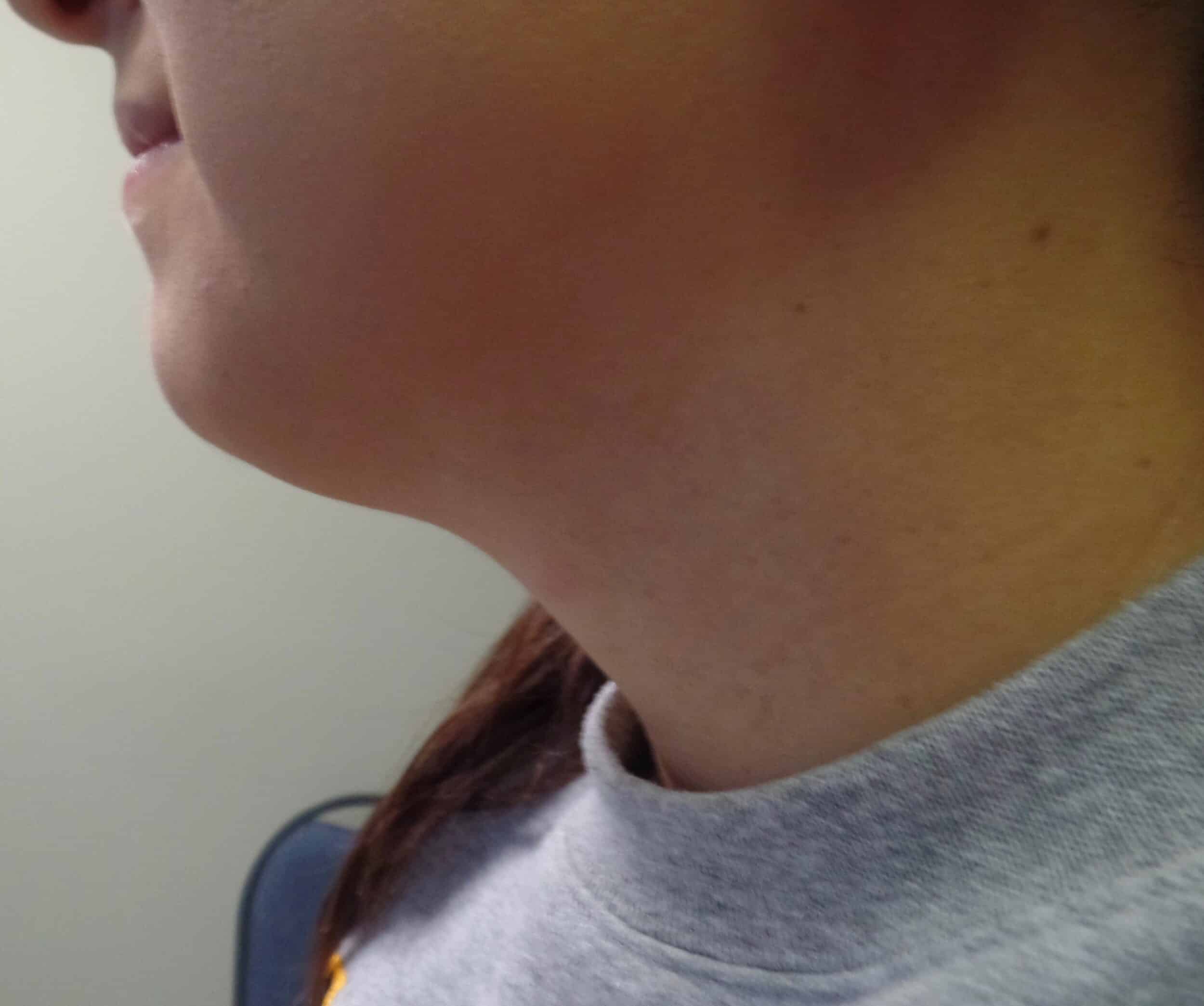 After Image: Facetite Chin - left-side
