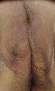 Vaginoplasty