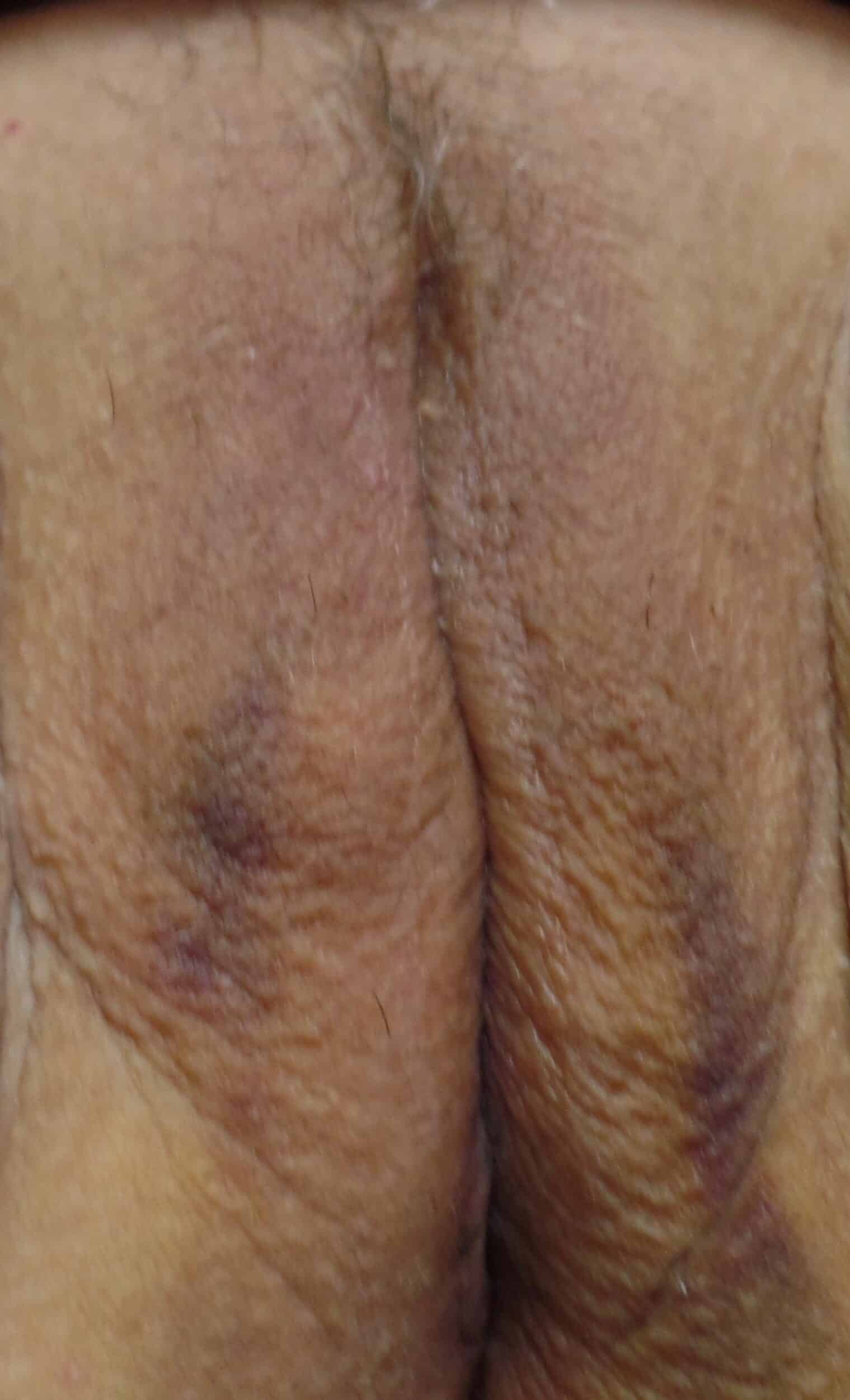 After Image: Vaginoplasty - front