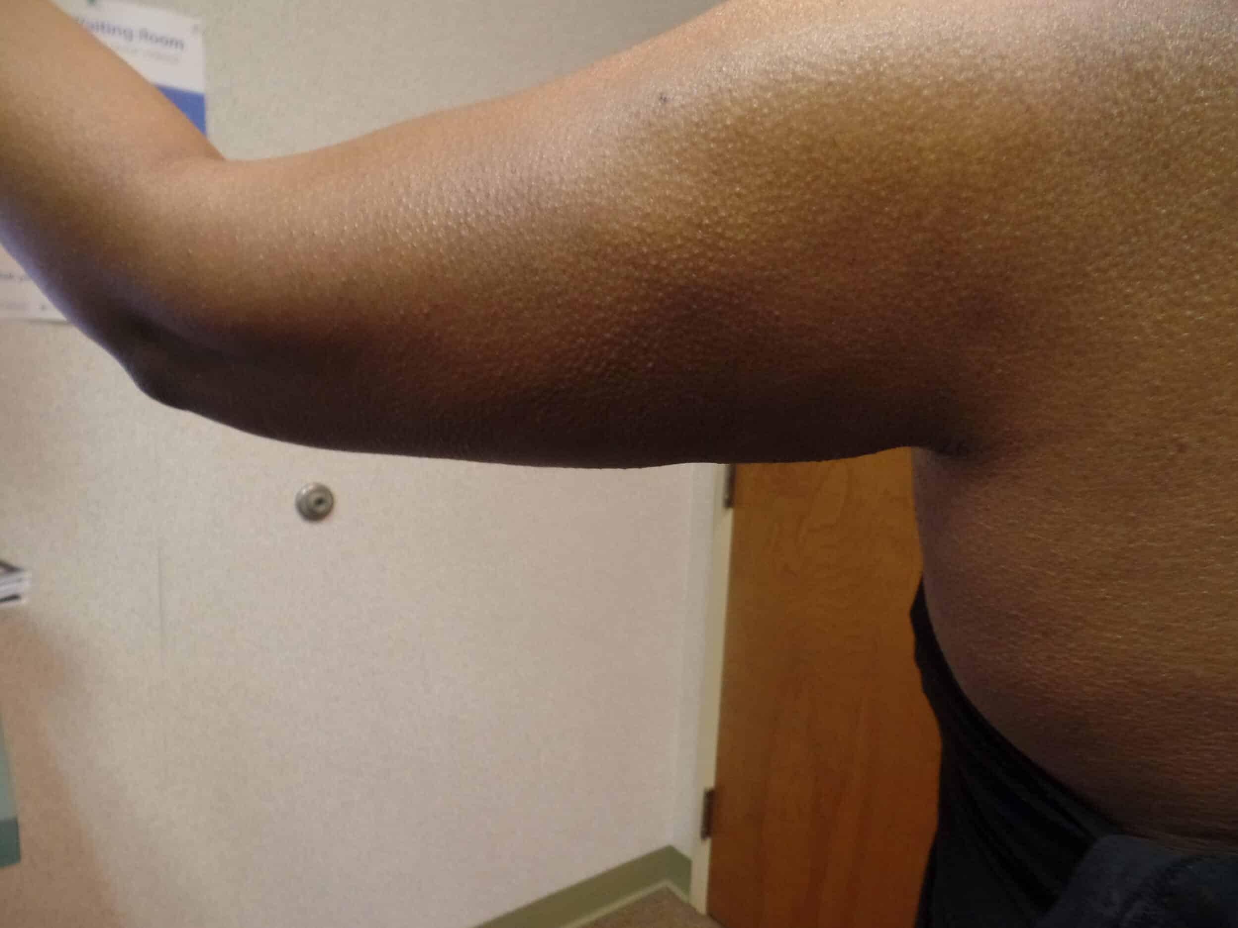After Image: Liposuction Arms - back