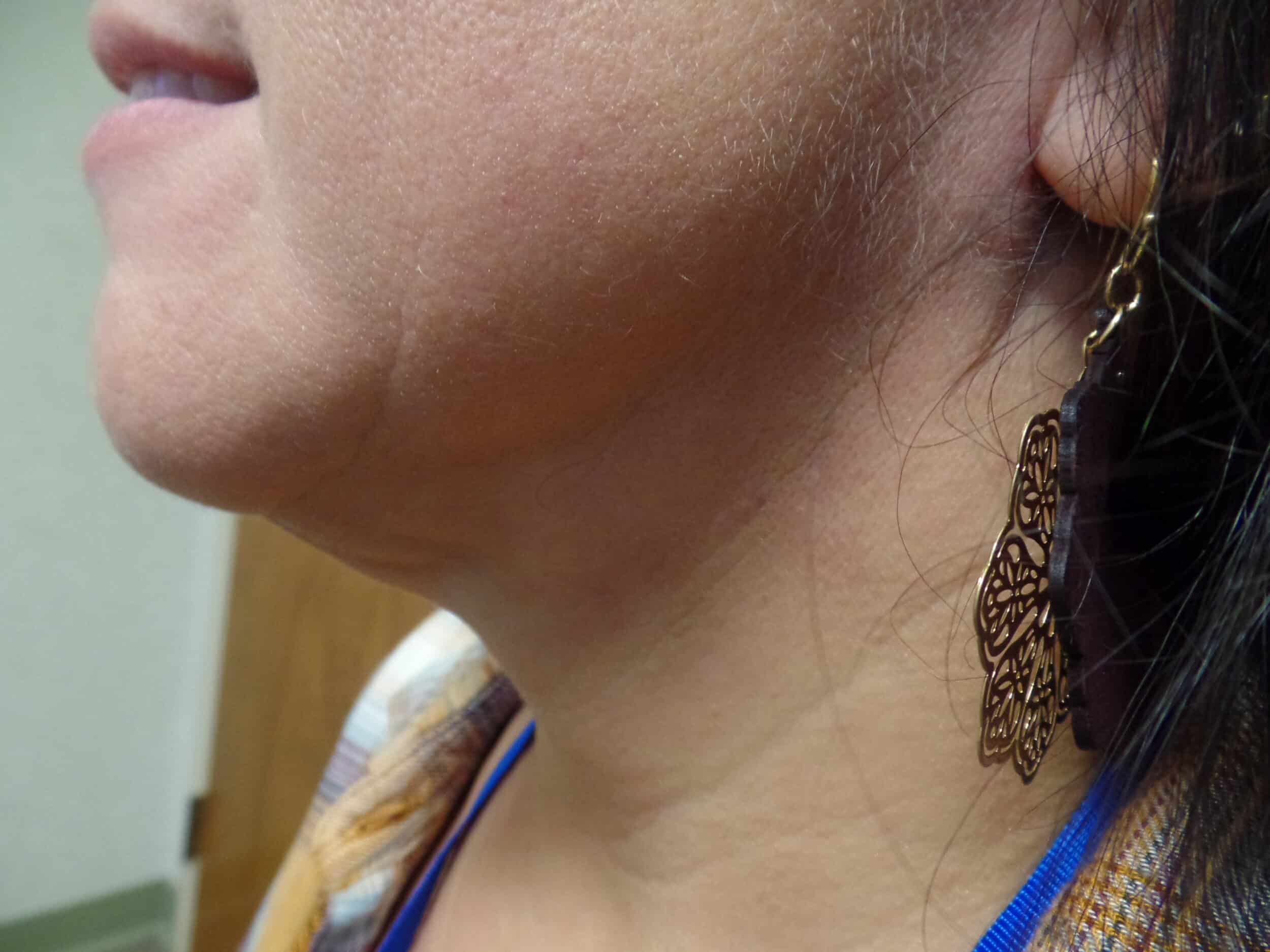 After Image: Facetite Chin and Jowls - left-side