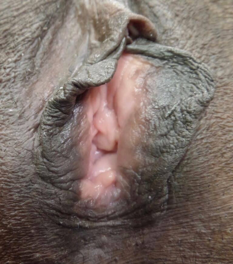 Before Image: Vaginoplasty - front