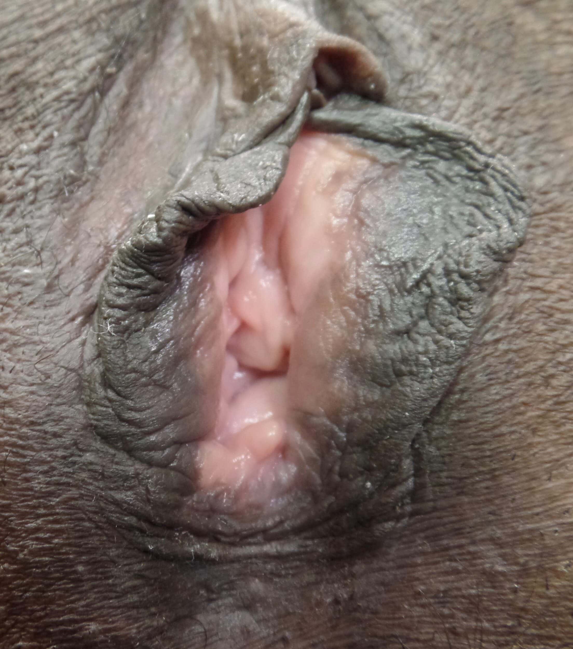 Before Image: Vaginoplasty - front