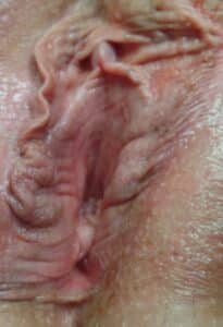 Vaginoplasty