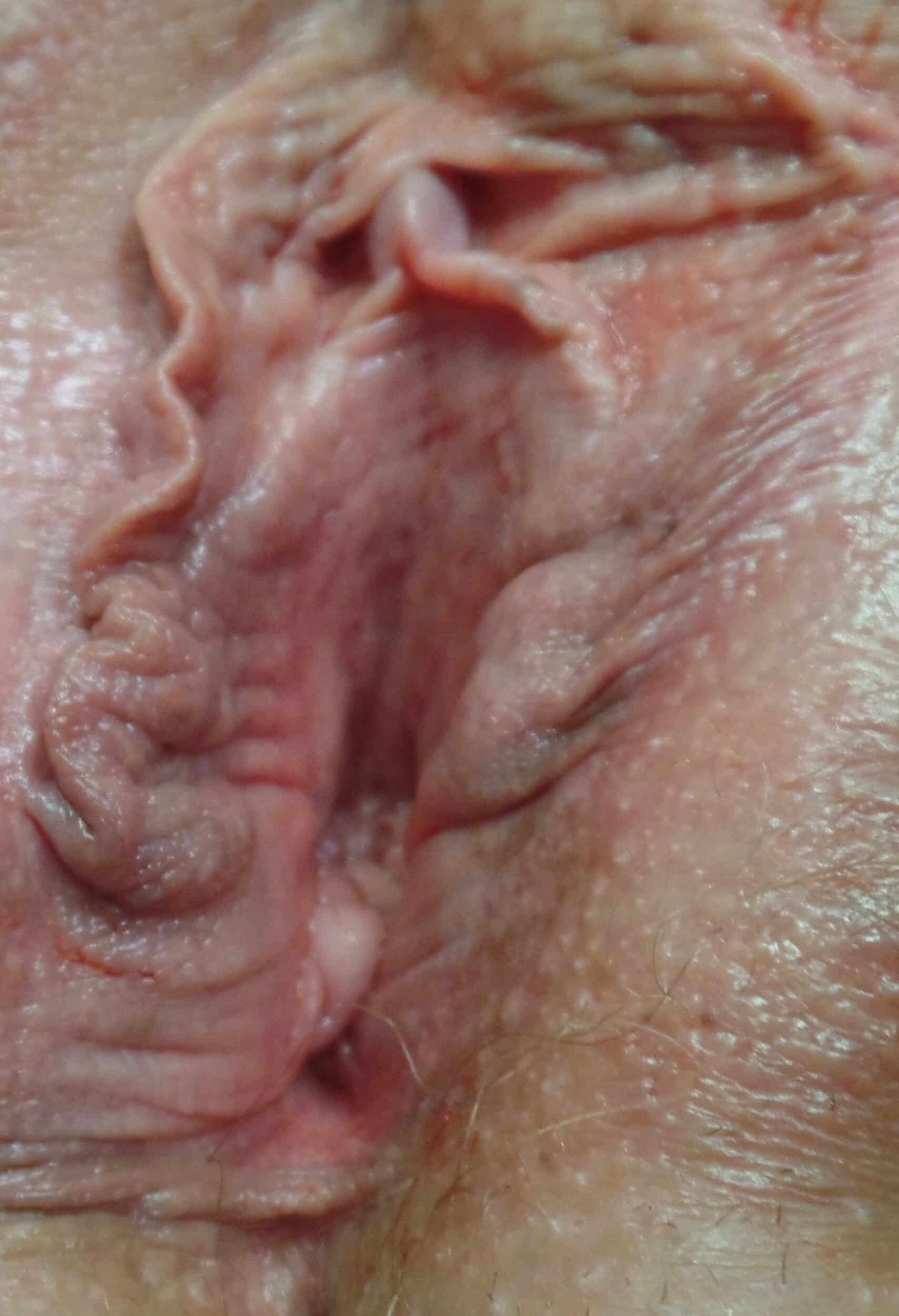 Before Image: Vaginoplasty - front