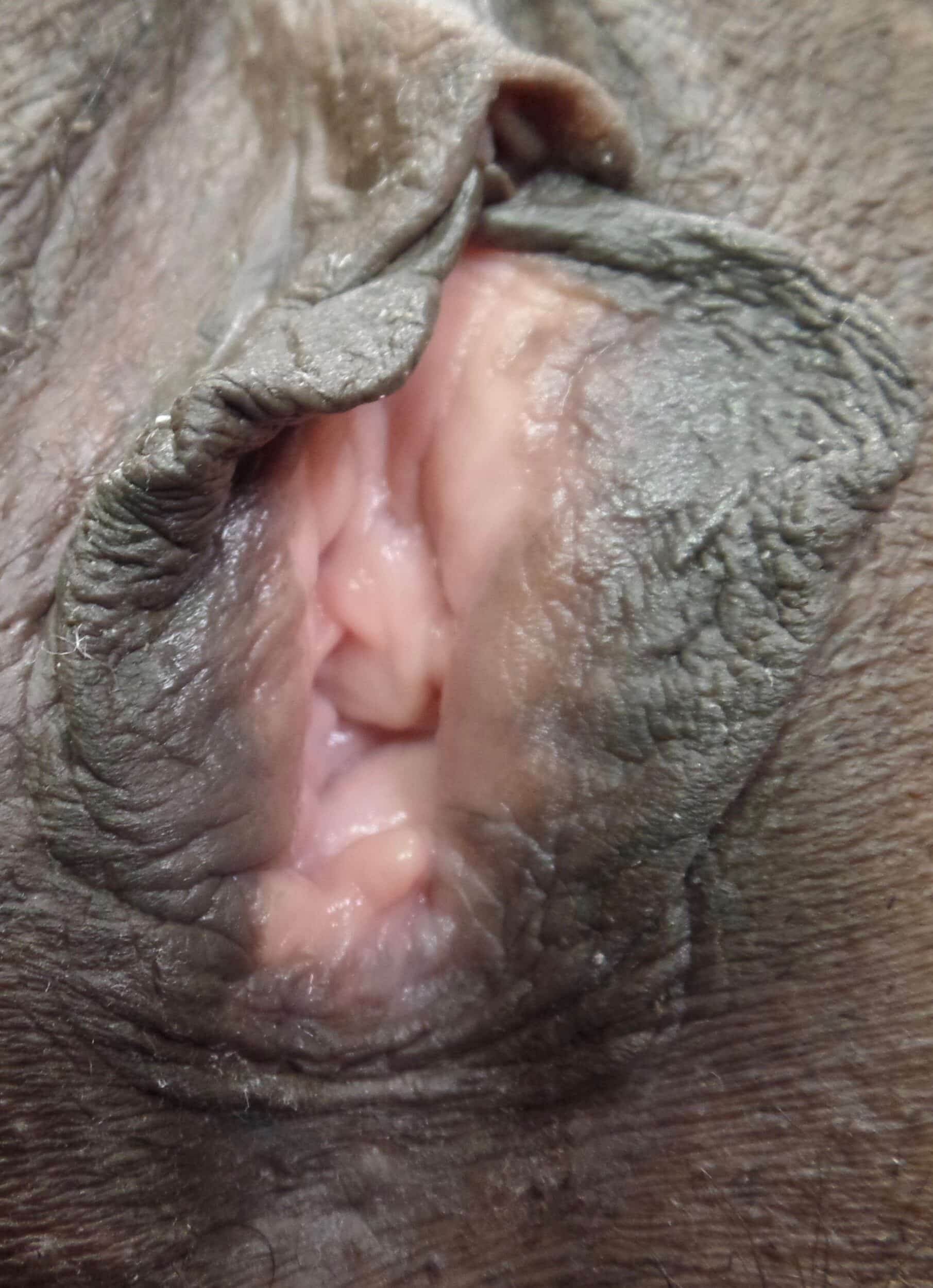 Before Image: Vaginoplasty - front