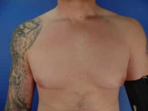 Liposuction for gynecomastia