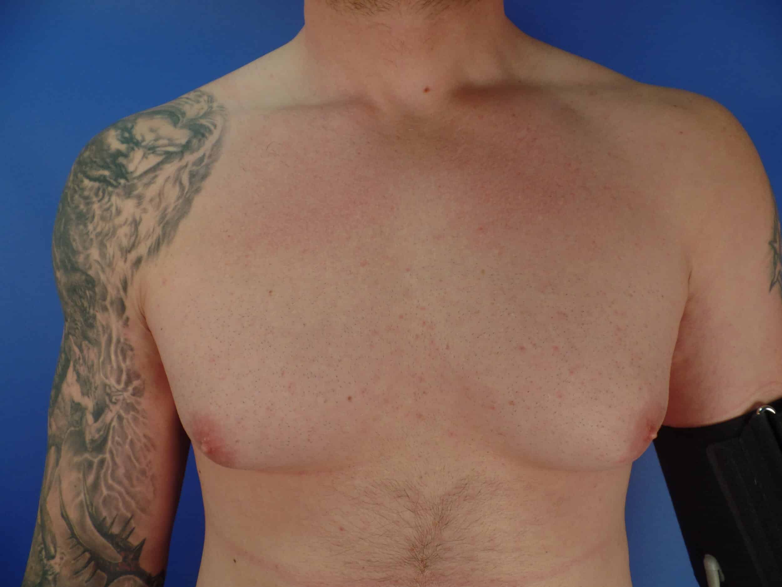 Before Image: Liposuction for gynecomastia - front