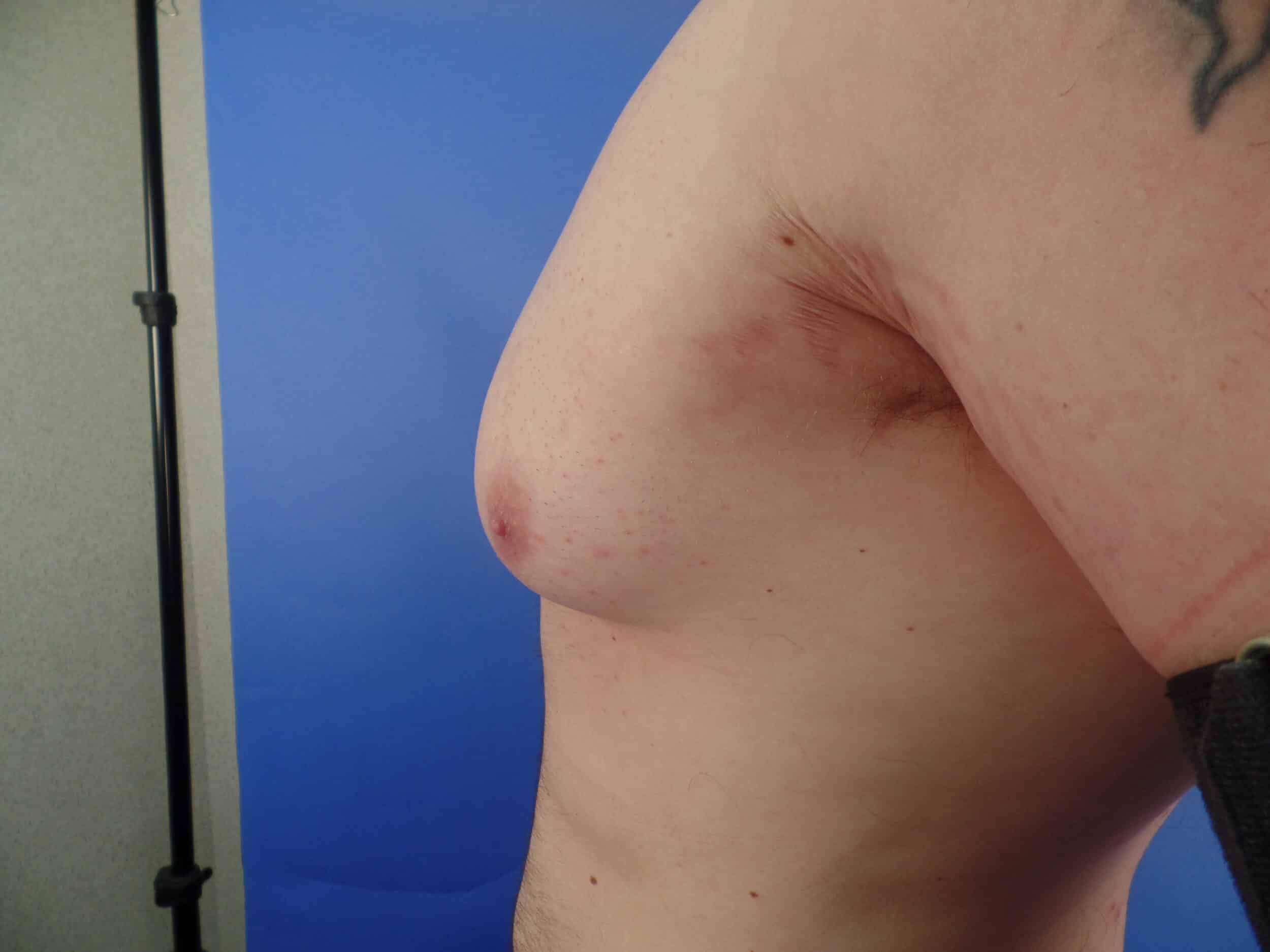 Before Image: Liposuction for Gynecomastia - front