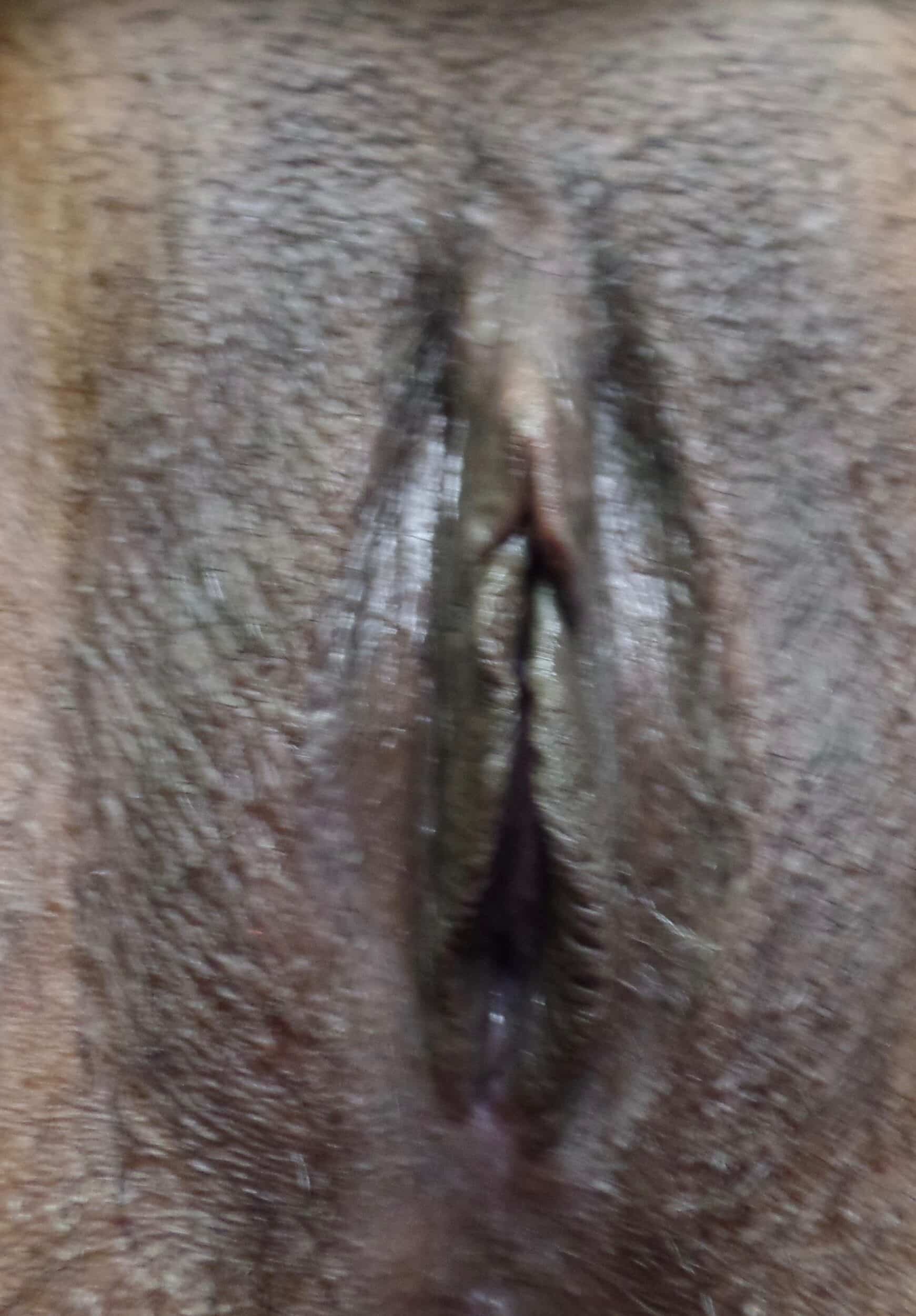 After Image: Vaginoplasty - front