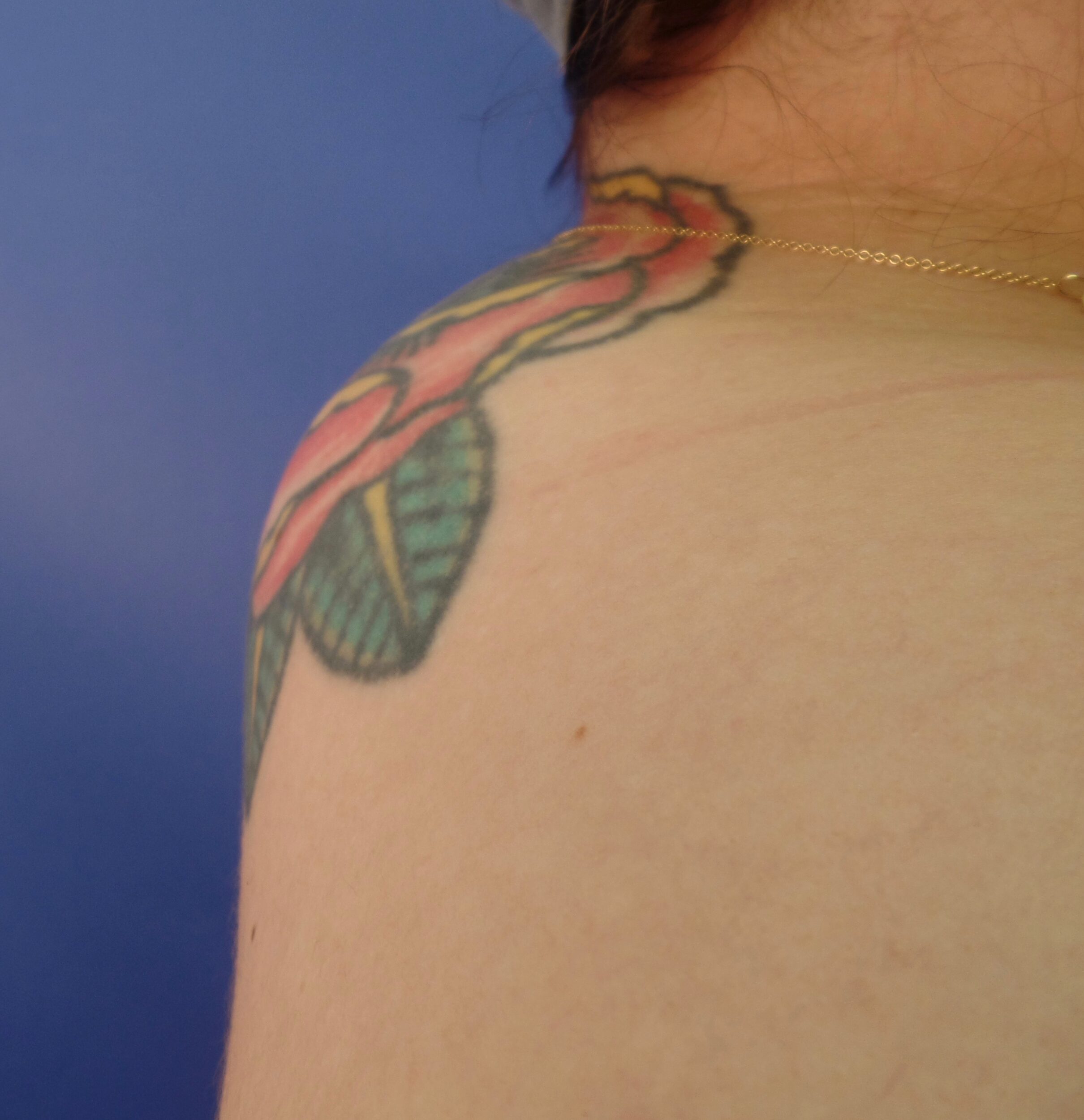 Before Image: Bodytite Buffalo hump - left-side