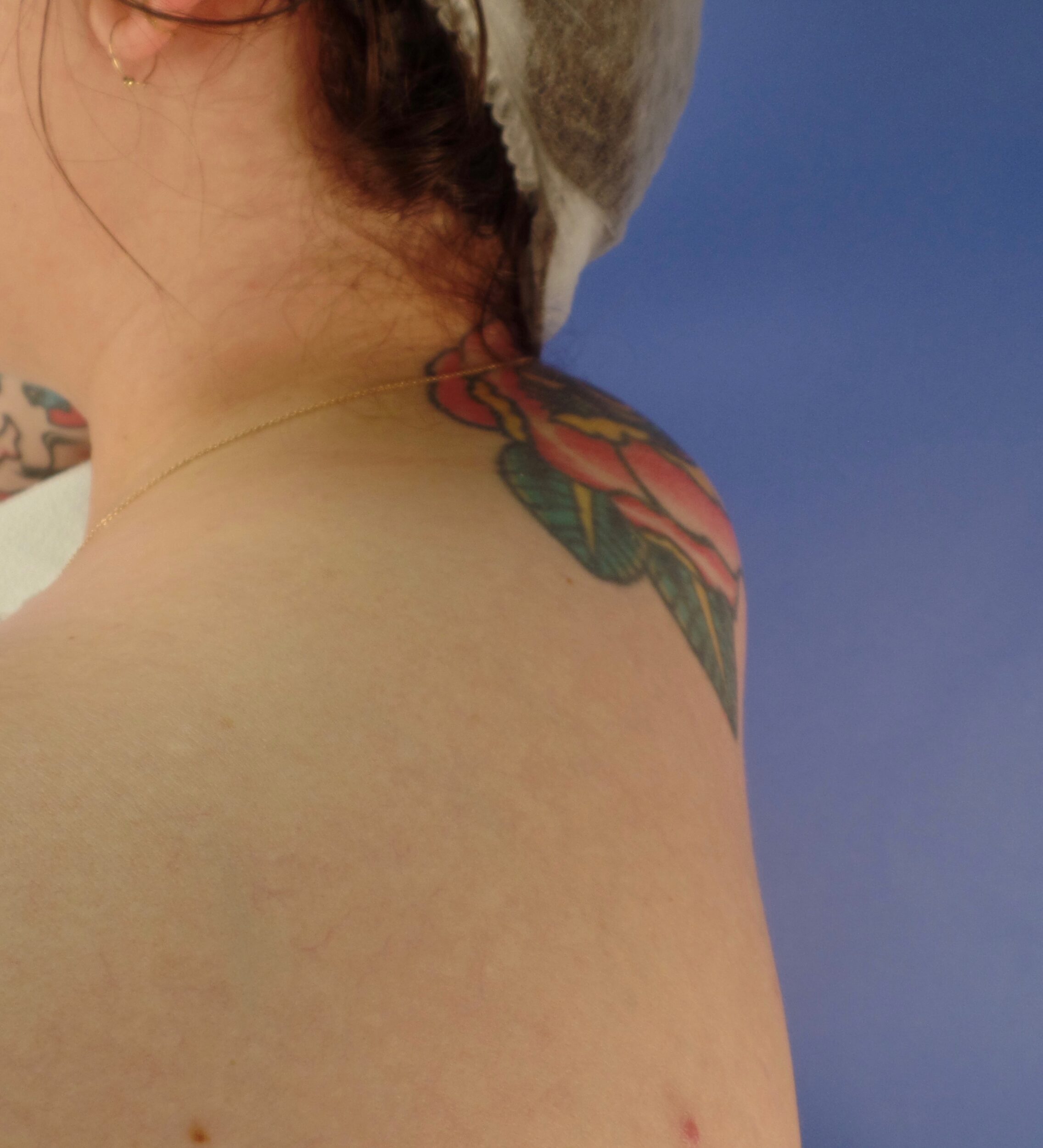 Before Image: Liposuction Buffalo Hump - front