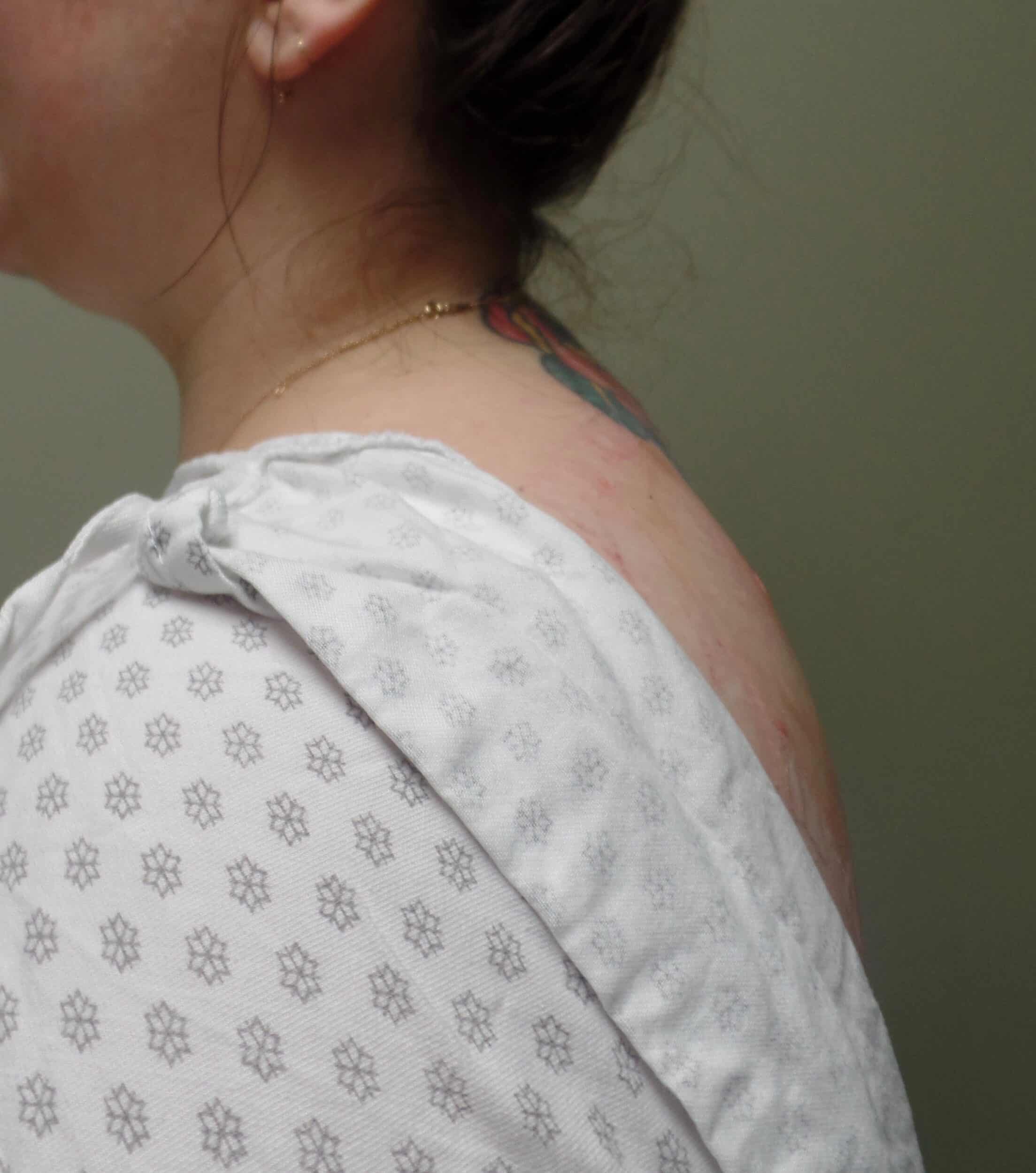 After Image: Liposuction Buffalo Hump - front