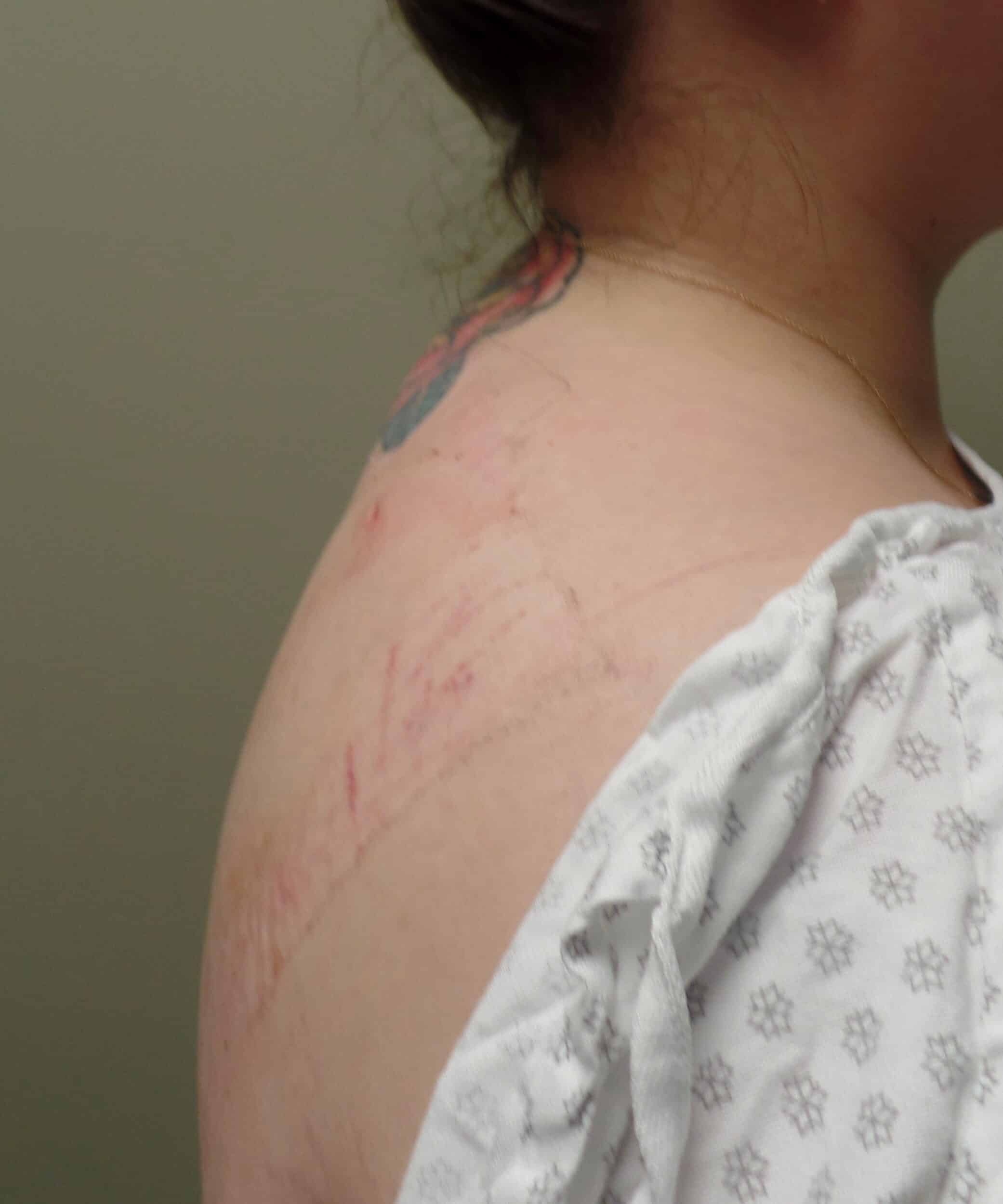 After Image: Bodytite Buffalo hump - left-side