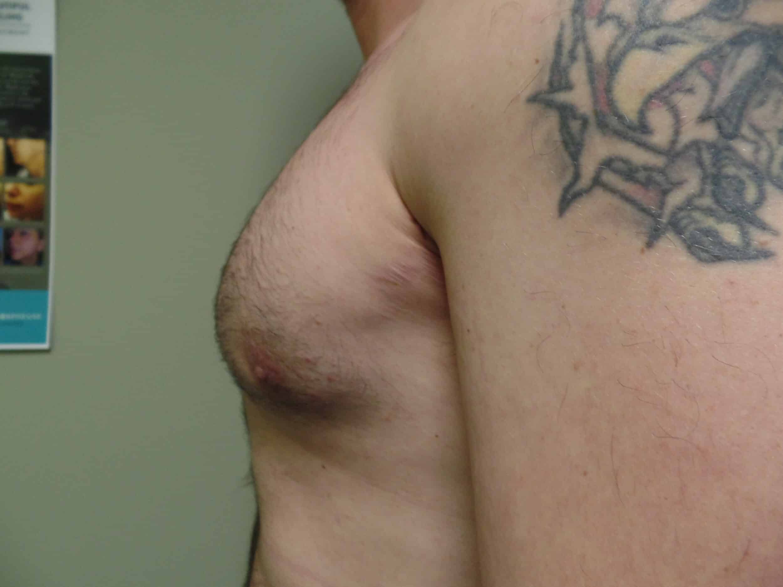 After Image: Liposuction for Gynecomastia - front