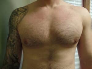 Liposuction for gynecomastia