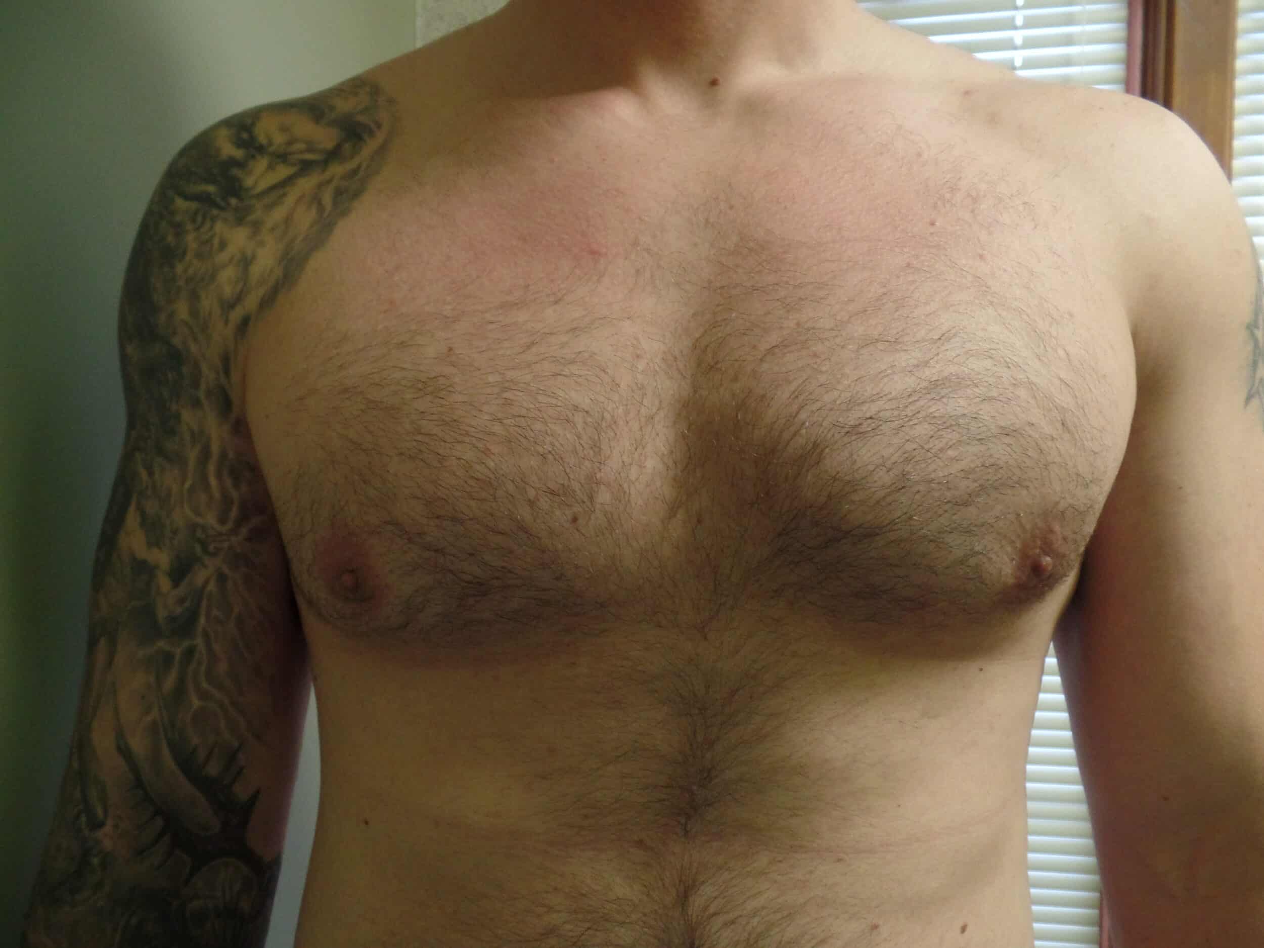 After Image: Liposuction for gynecomastia - front