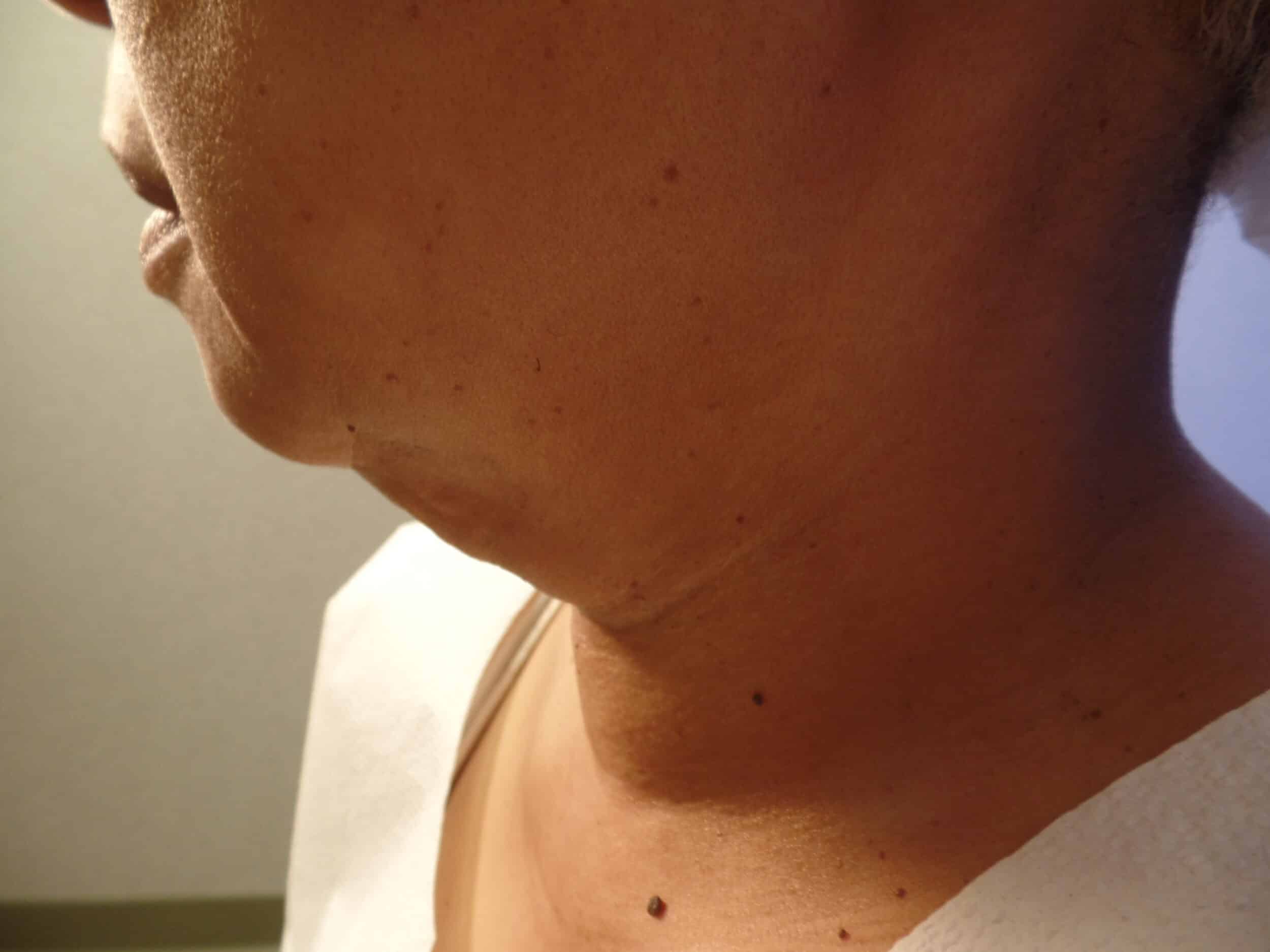 Before Image: FaceTite and Liposuction - left-side