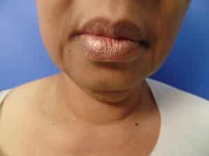 FaceTite and Liposuction