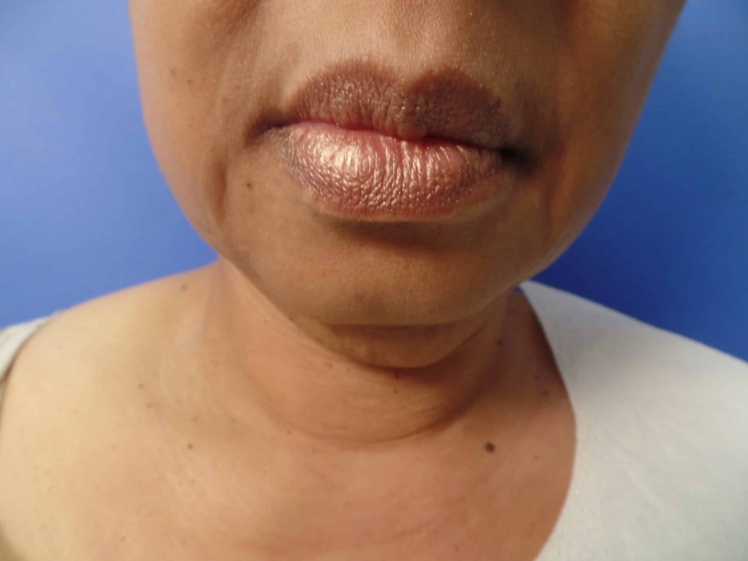 Before Image: FaceTite and Liposuction - front