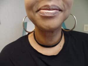 FaceTite and Liposuction