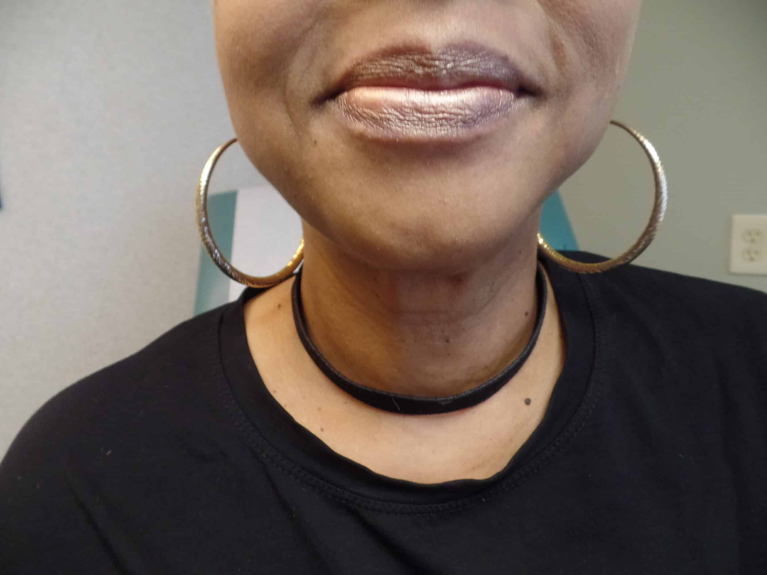 After Image: FaceTite and Liposuction - front