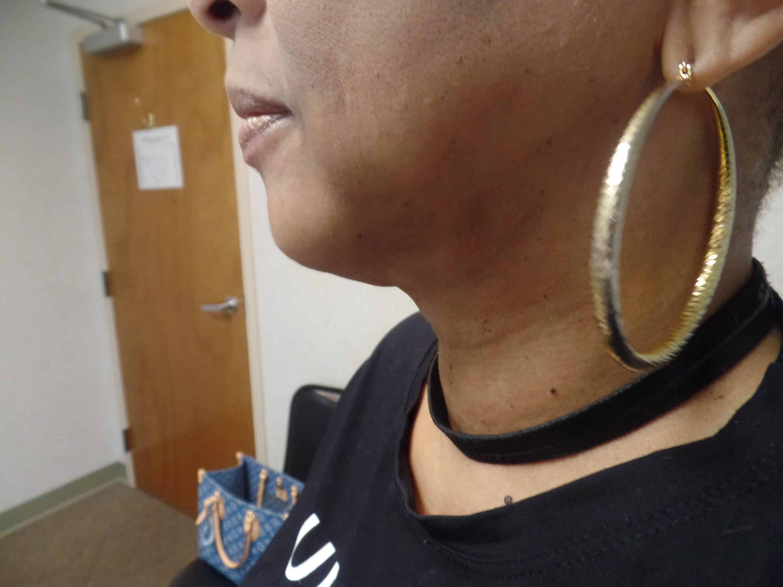 After Image: FaceTite and Liposuction - left-side