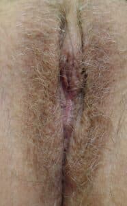 Labiaplasty