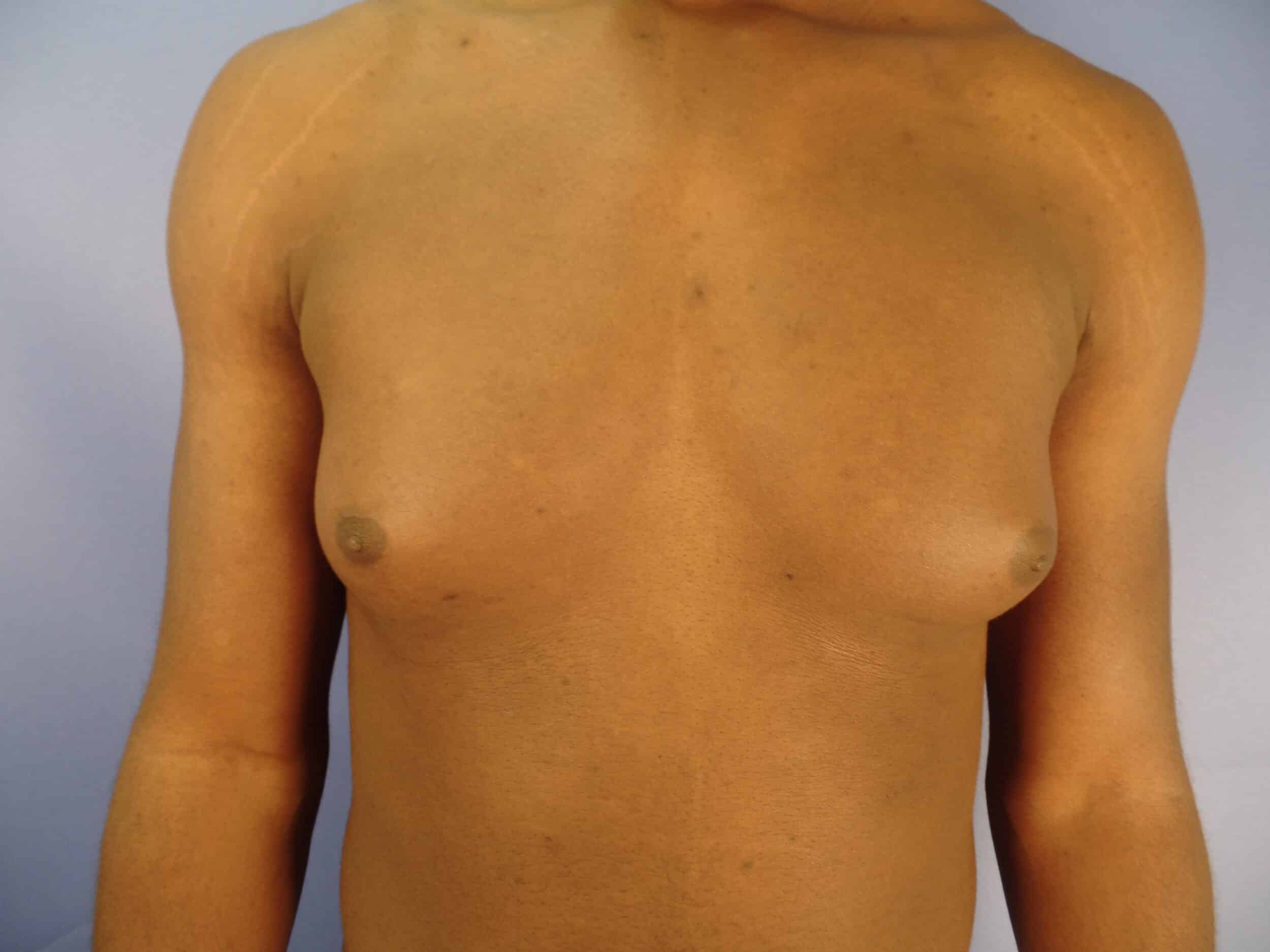 Before Image: GYNECOMASTIA / POST OP DAY 1 - front