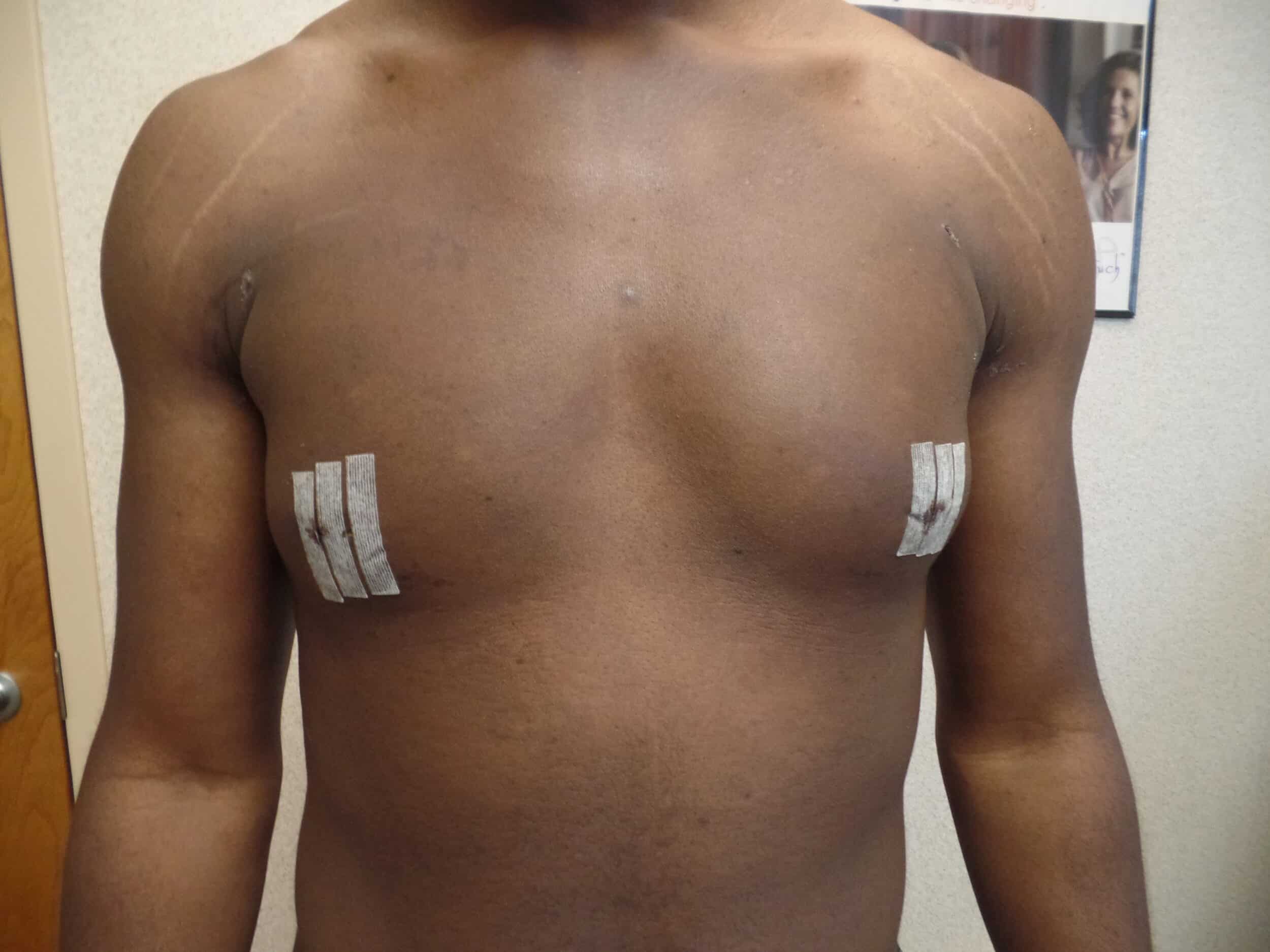 After Image: GYNECOMASTIA / POST OP DAY 1 - front