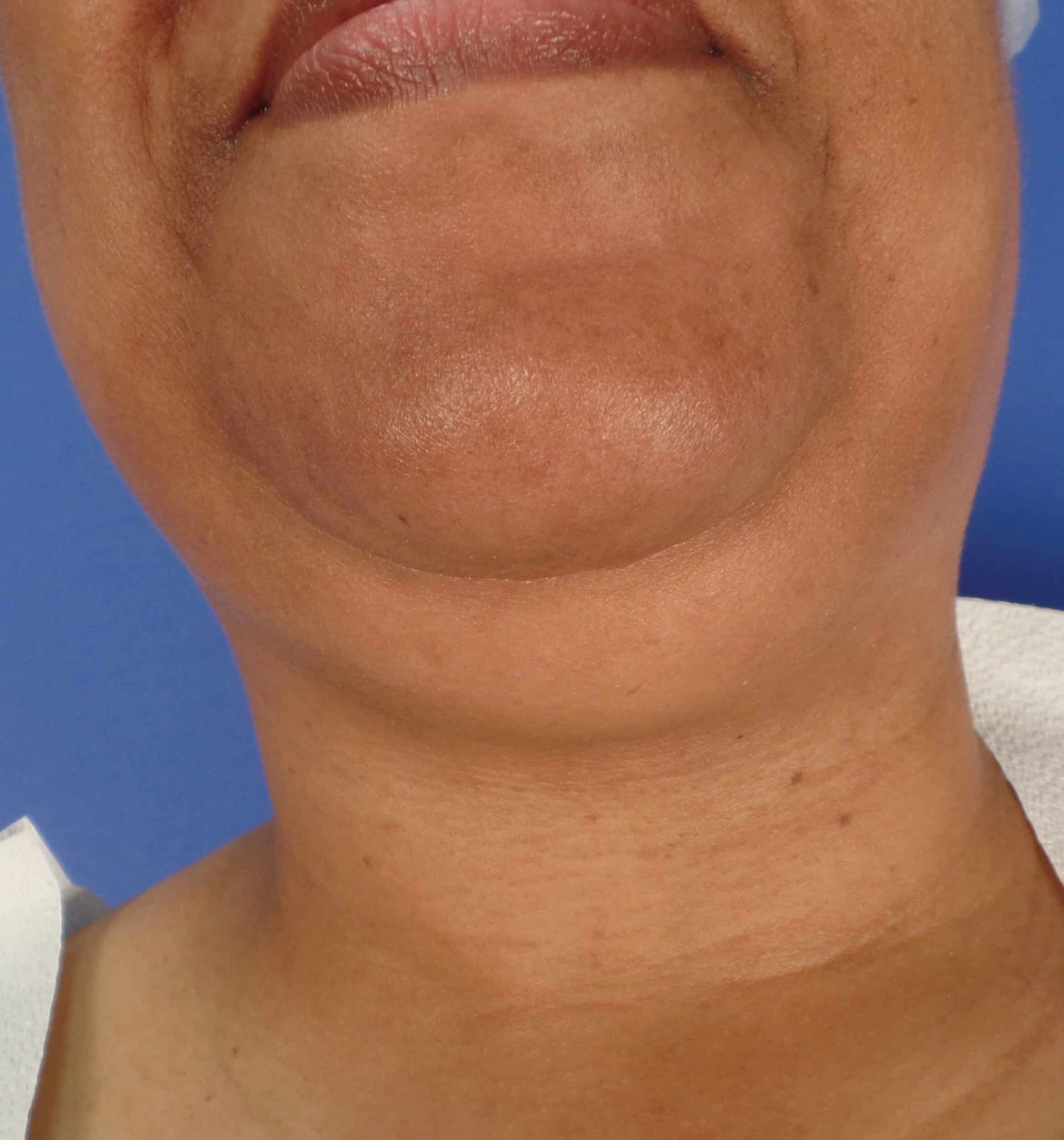 Before Image: Liposuction of Chin and Neck - front