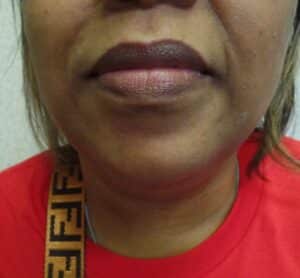 Facetite of chin and neck