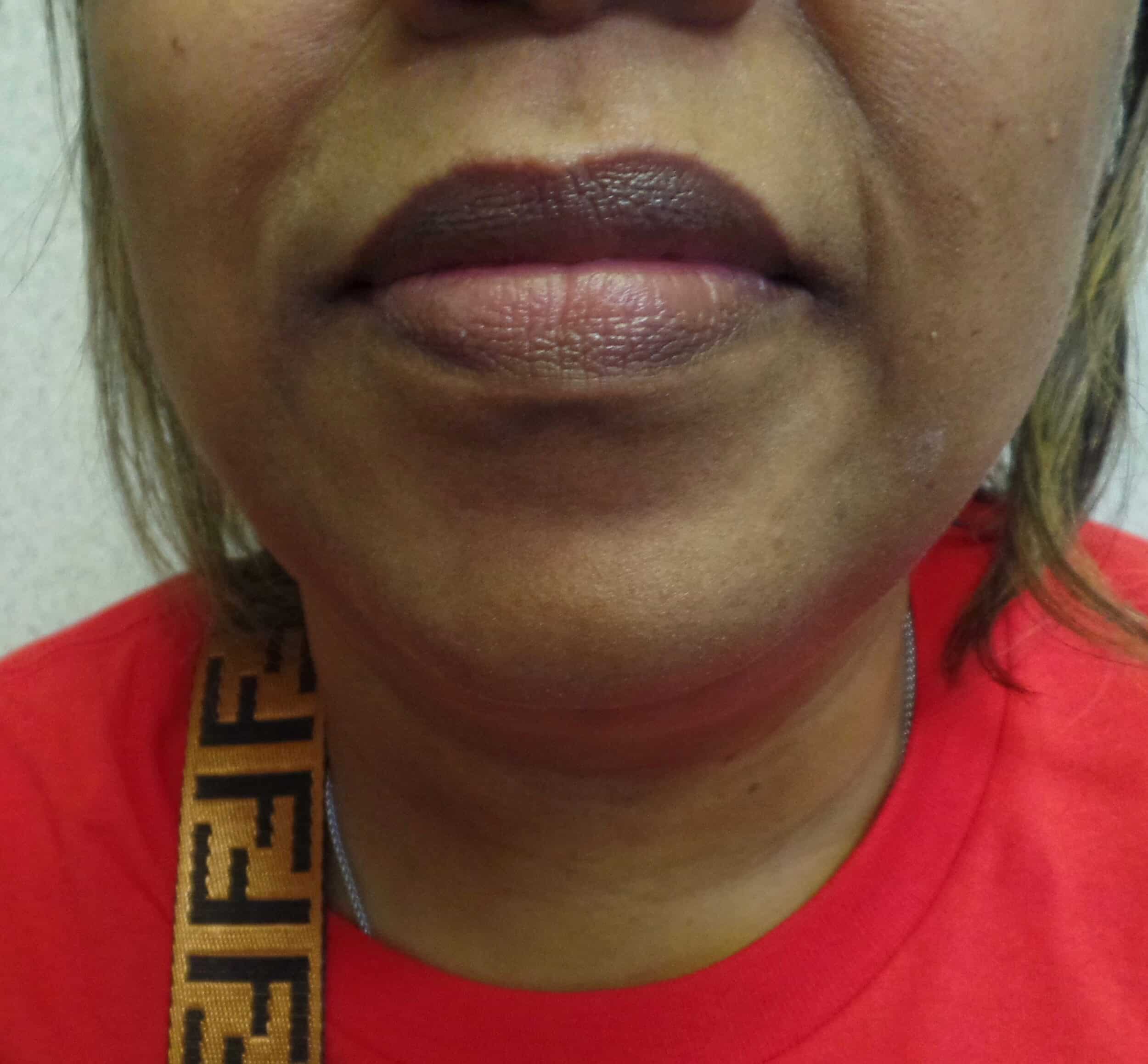 After Image: Liposuction of Chin and Neck - front