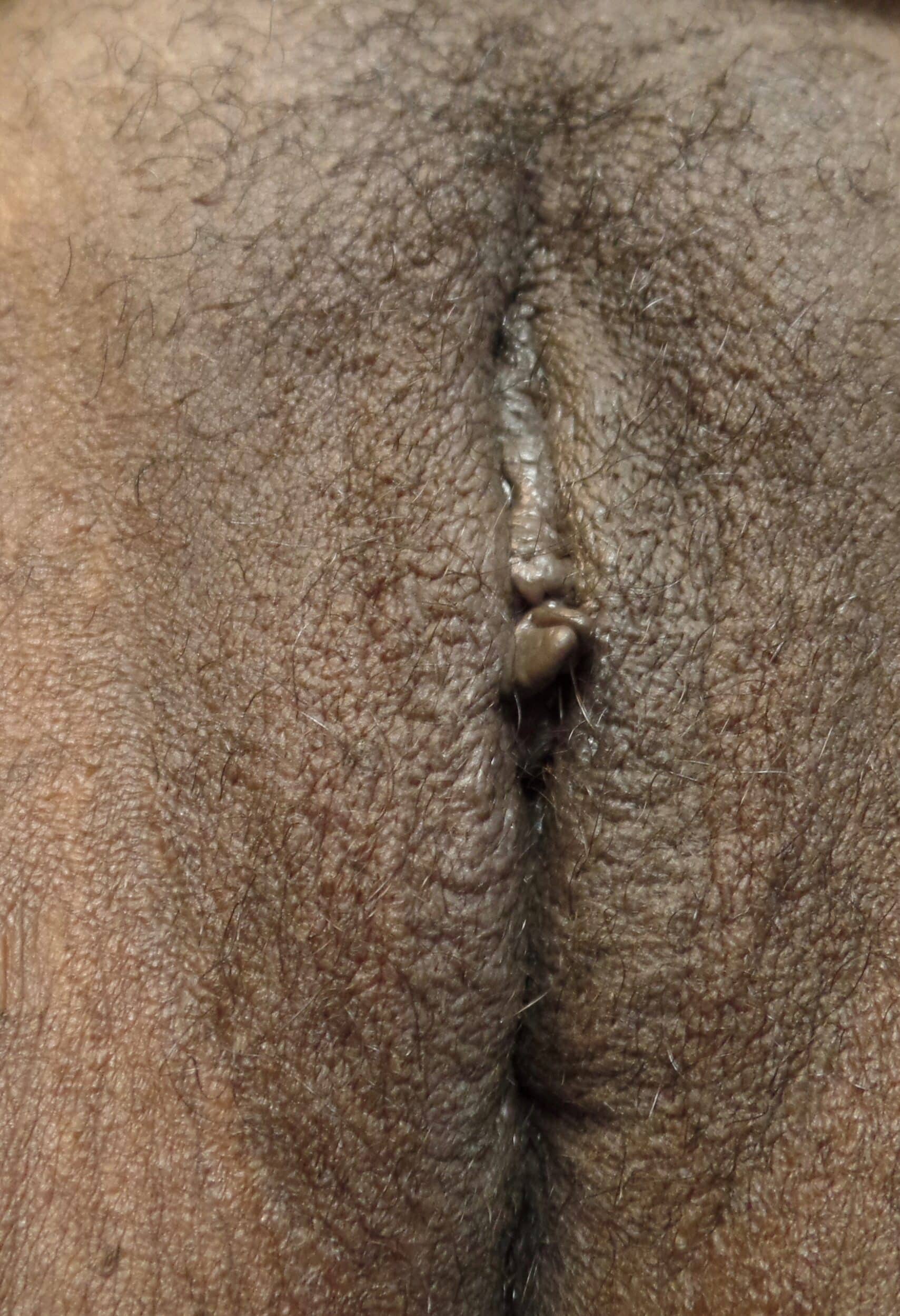 After Image: Vaginoplasty - front