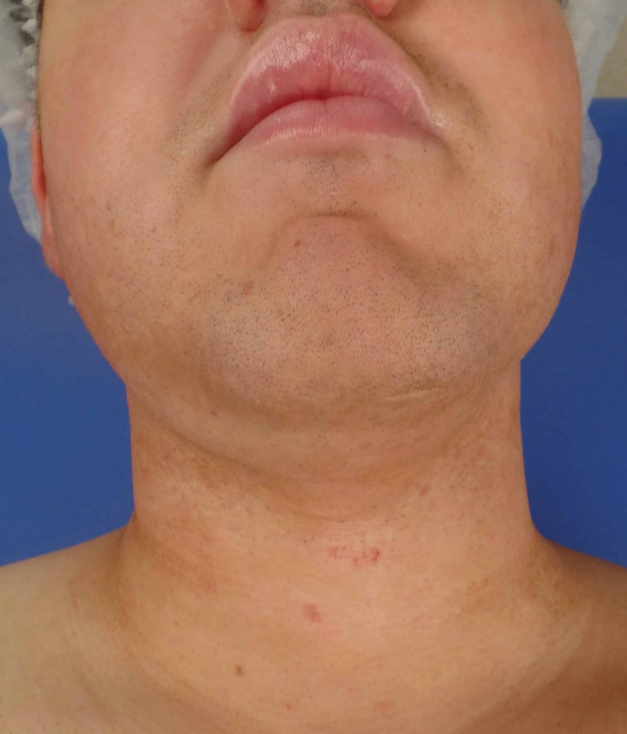 Before Image: Liposuction and FaceTite of the chin - front