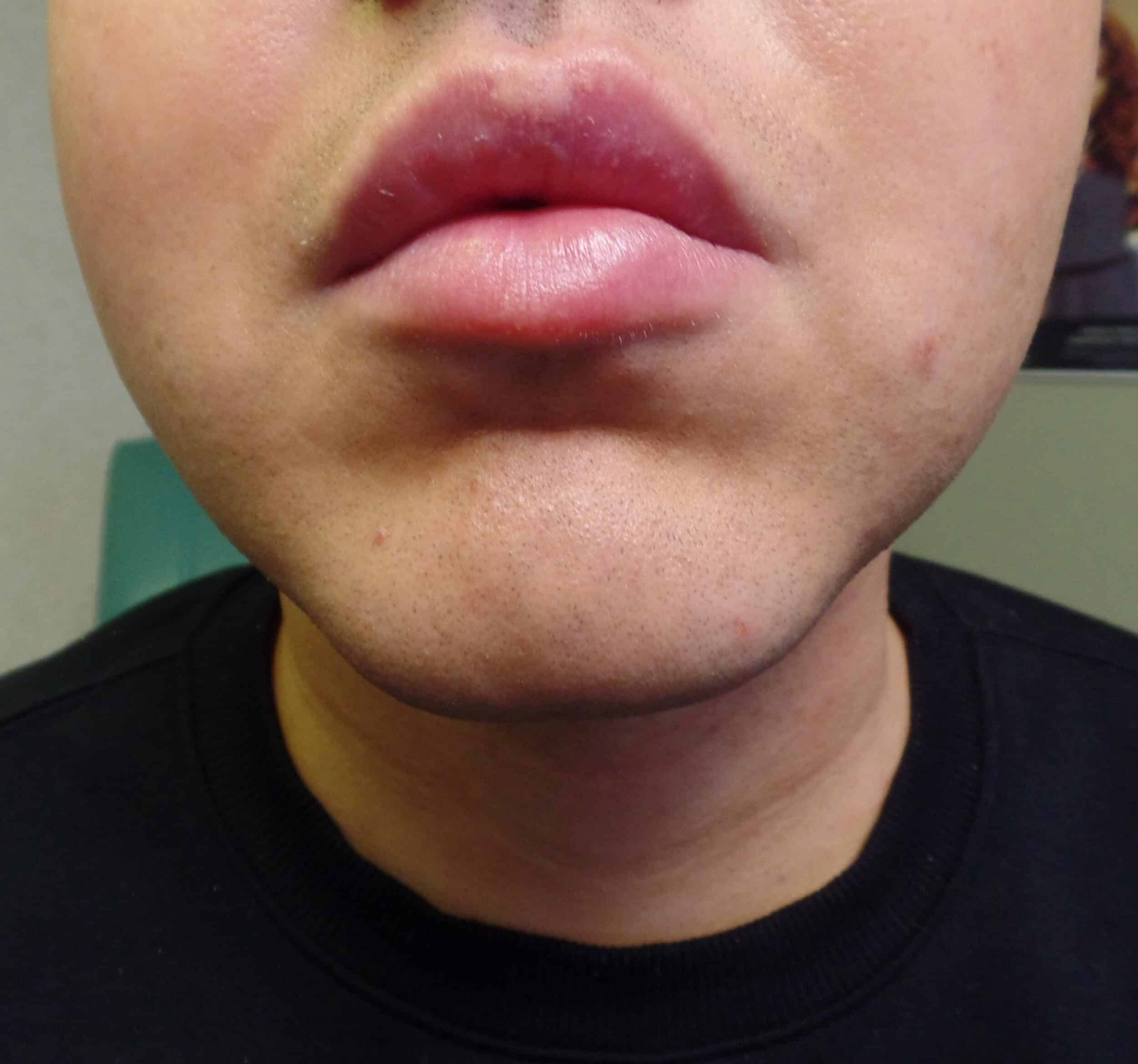 After Image: Liposuction and FaceTite of the chin - front