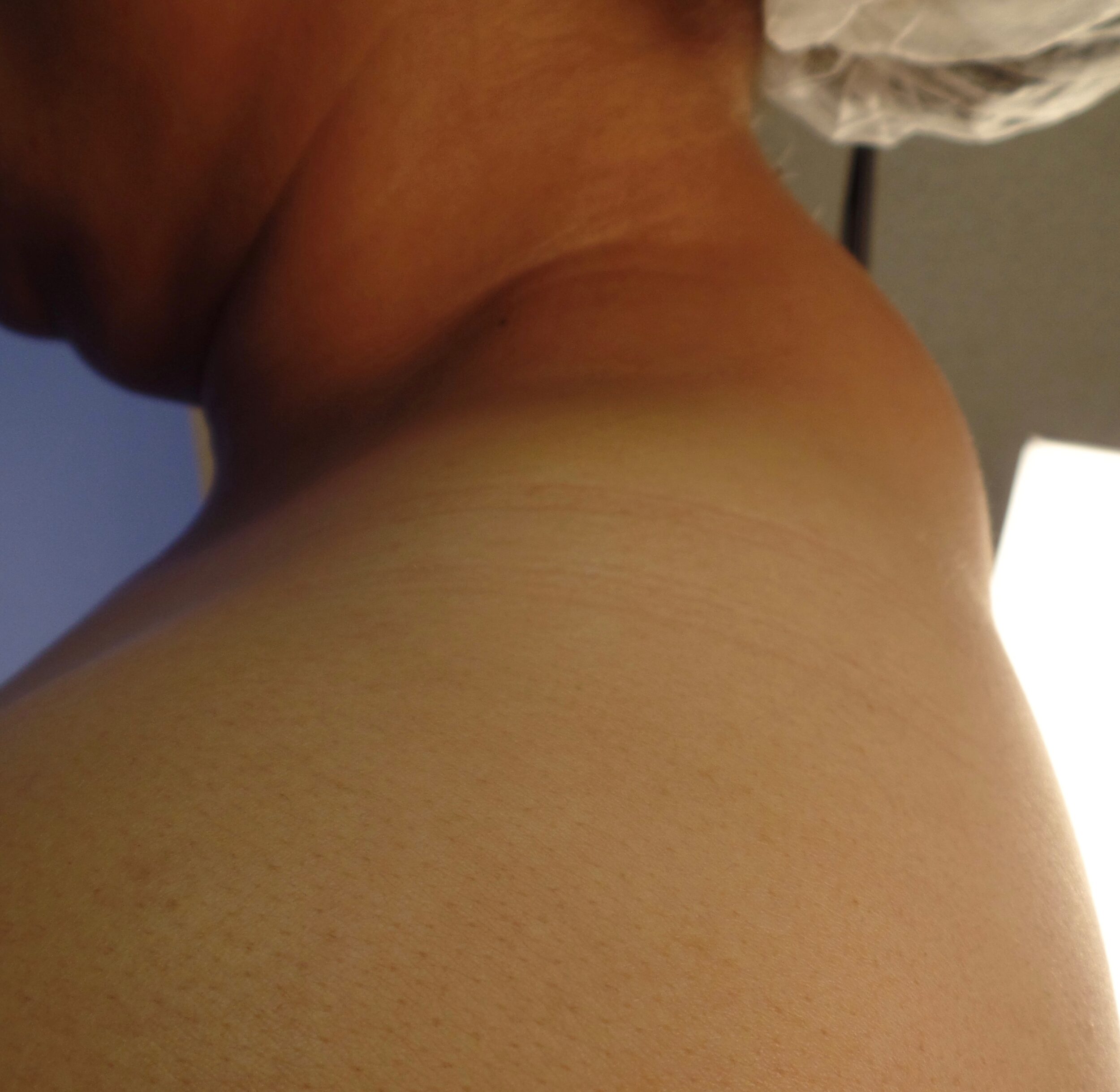 Before Image: Buffalo Hump - left-side