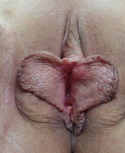Labiaplasty