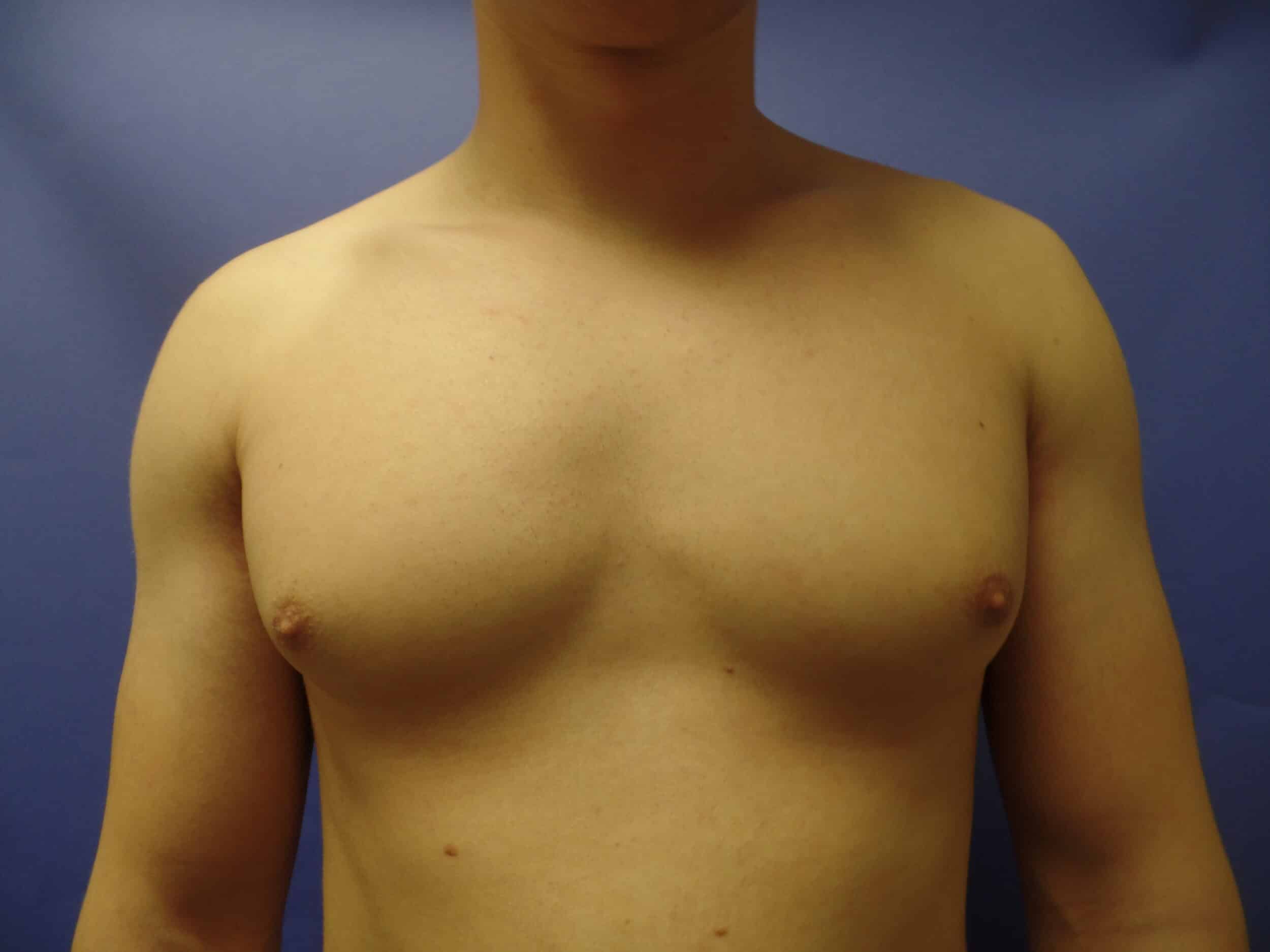 Before Image: Gynecomastia treated with liposuction - front