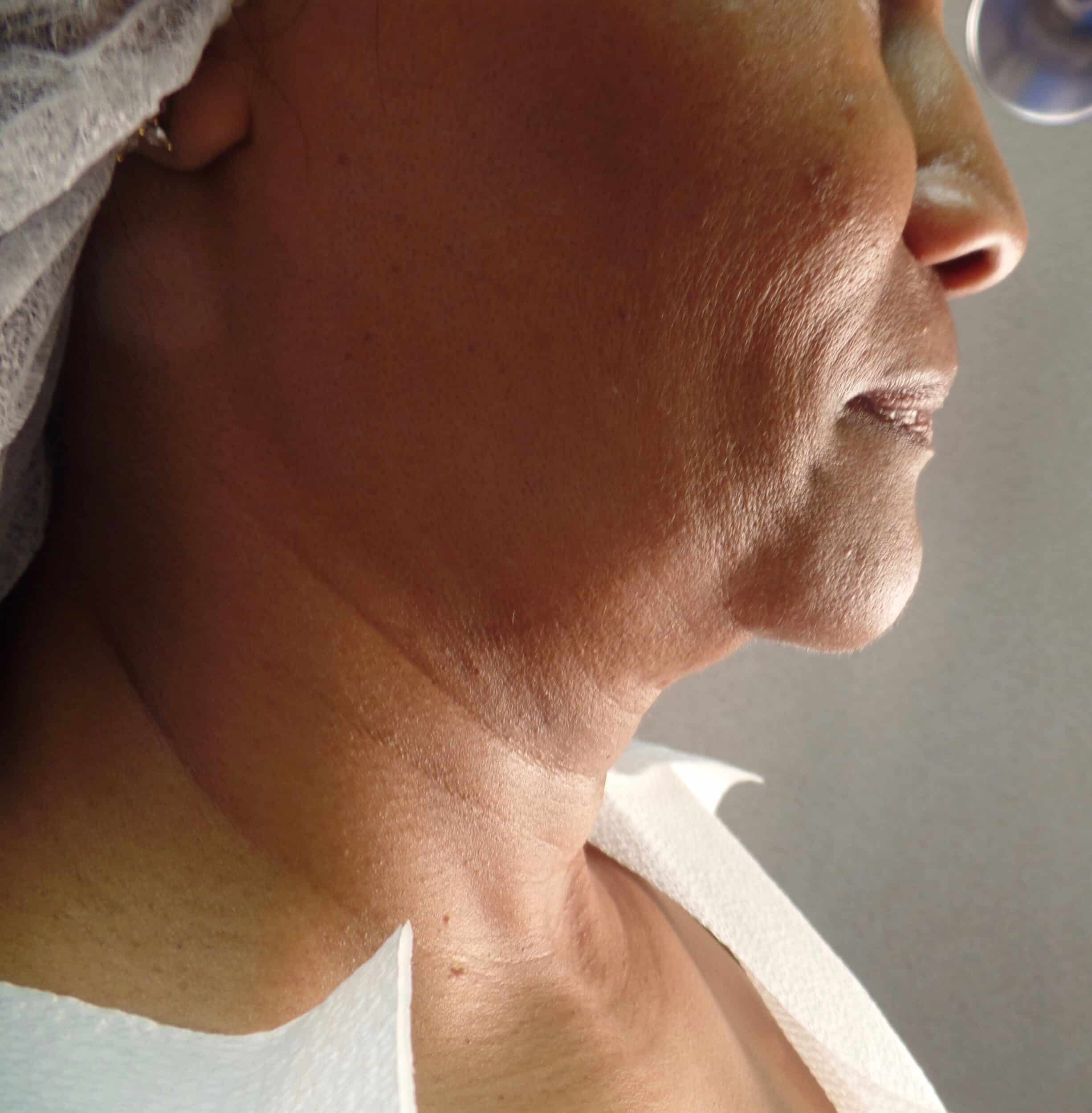 Before Image: FaceTite Chin, Neck and Jowls - right-side