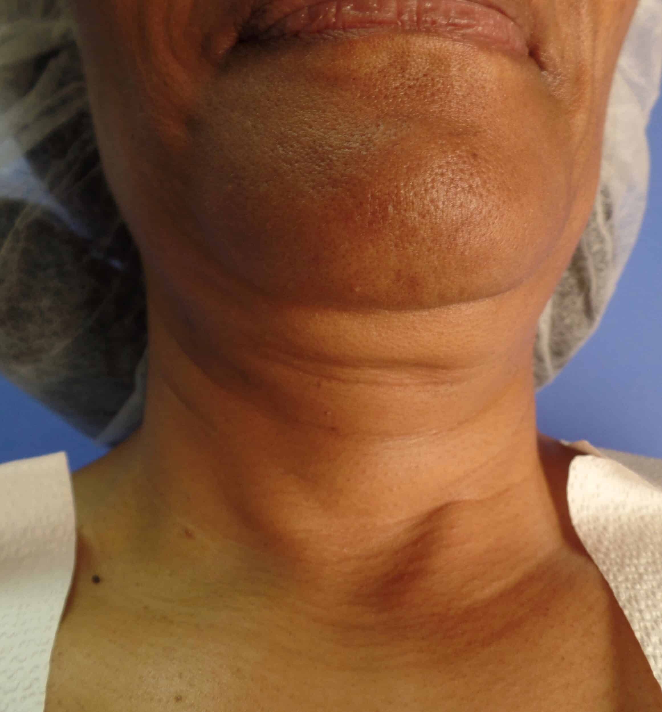 Before Image: FaceTite Chin, Neck and Jowls - front